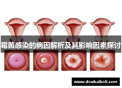 霉菌感染的病因解析及其影响因素探讨